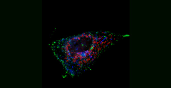 Breast cancer cell with fluorescence microscopy that reveals three important cellular structures: mitochondria (red), early endosomes (green), and late endosomes/lysosomes (blue)