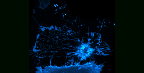 The cervical cancer cell shown here is undergoing ‘apoptosis,’ programmed cell death, which occurs when the CD95 death receptor on the surface of the cell is triggered by its ligand, the molecule CD95L