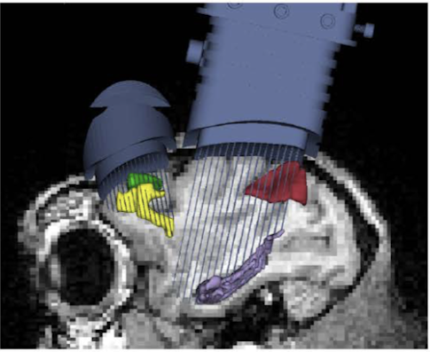 electrodes in brain