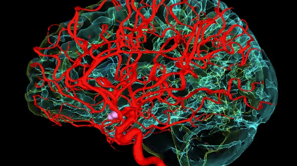 Blood vessels supplying the brain. Digitally enhanced 3D magnetic resonance imaging (MRI) scan and digital subtraction angiography (DSA) scan, showing the blood vessels that supply the human brain.