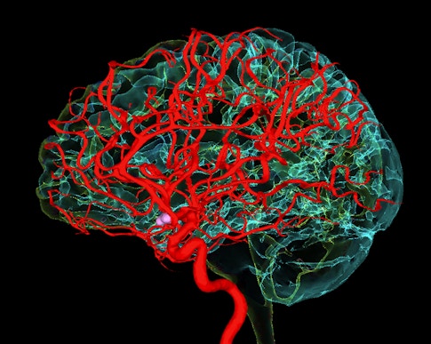 Blood vessels supplying the brain. Digitally enhanced 3D magnetic resonance imaging (MRI) scan and digital subtraction angiography (DSA) scan, showing the blood vessels that supply the human brain.