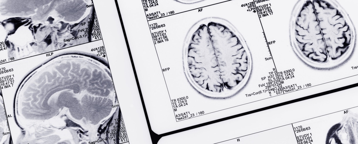 Series of MRI (Magnetic Resonance Imaging) brain scans.