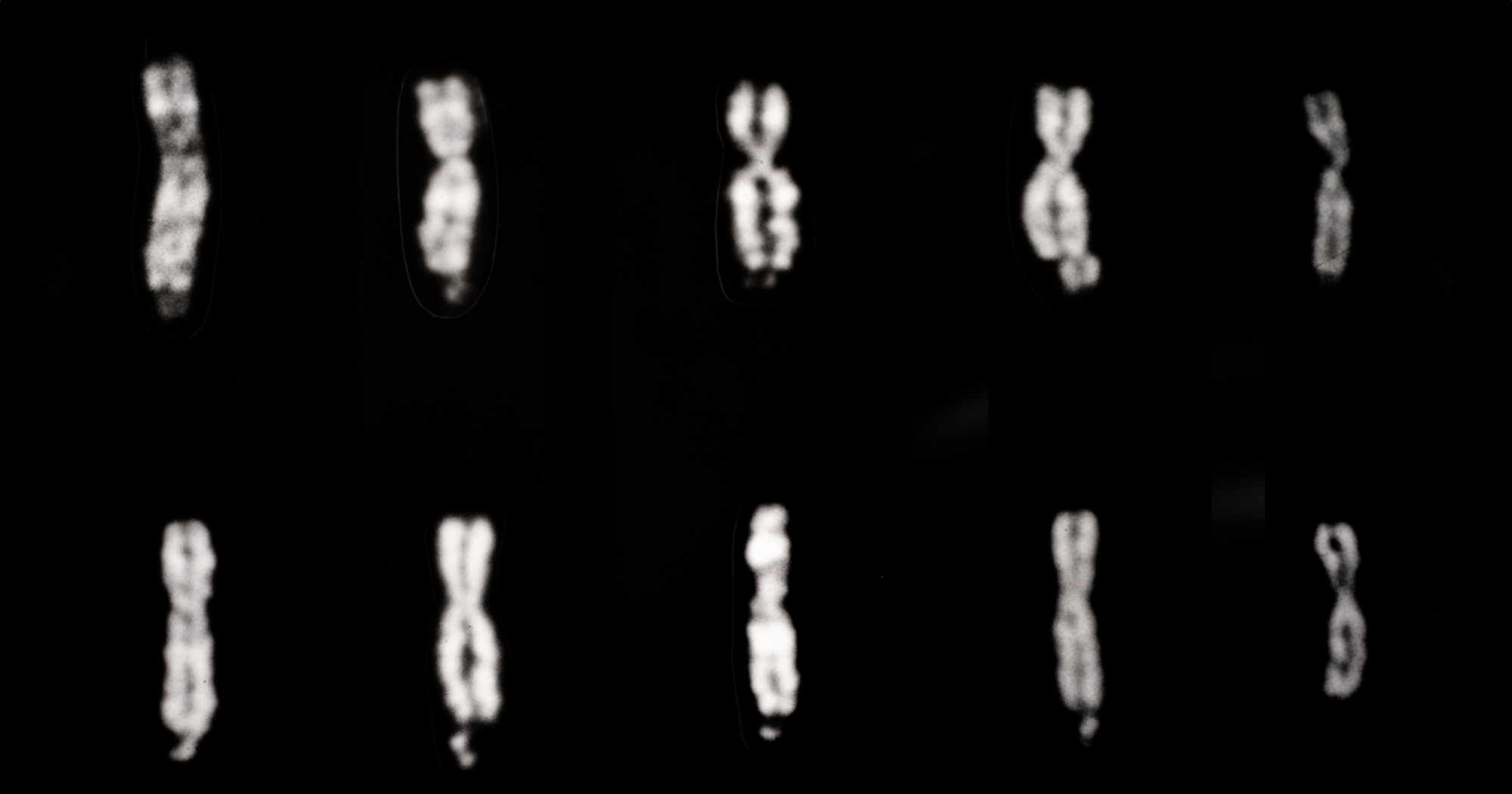 Black-and-white micrograph showing ten human X chromosomes arranged in two rows against a dark background. Several chromosomes display the characteristic fragile-X appearance, with a narrowed or constricted region near the tip of the long arm that gives them a stretched or partially separated shape. Normal X chromosomes, shown on the right side for comparison, appear more uniformly condensed and lack the fragile-site constriction. The image illustrates Q-banded chromosome staining used to identify fragile X chromosome abnormalities.