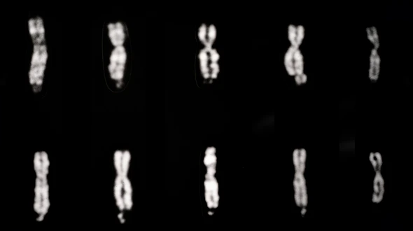 Black-and-white micrograph showing ten human X chromosomes arranged in two rows against a dark background. Several chromosomes display the characteristic fragile-X appearance, with a narrowed or constricted region near the tip of the long arm that gives them a stretched or partially separated shape. Normal X chromosomes, shown on the right side for comparison, appear more uniformly condensed and lack the fragile-site constriction. The image illustrates Q-banded chromosome staining used to identify fragile X chromosome abnormalities.